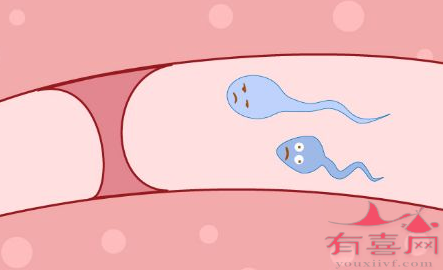 邯郸试管助孕高端群-输卵管近端堵塞会导致不孕吗？(图1)