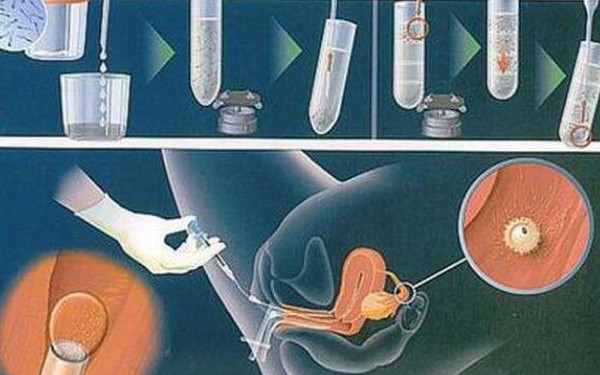 南宁单身供卵试管助孕：人工授精和试管婴儿的区别以及如何决定。(图1)